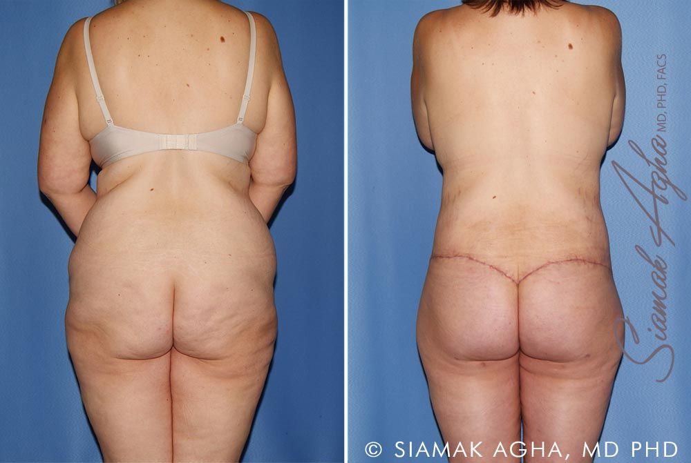 Total Body Lift Before & After