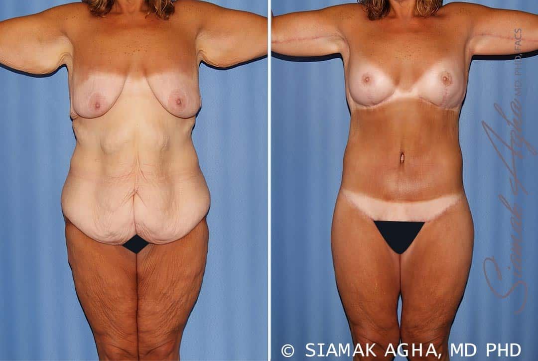 Total Body Lift Before & After