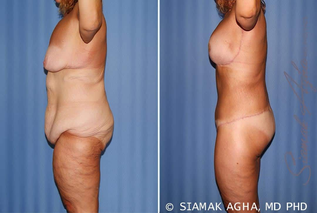 Total Body Lift Before & After