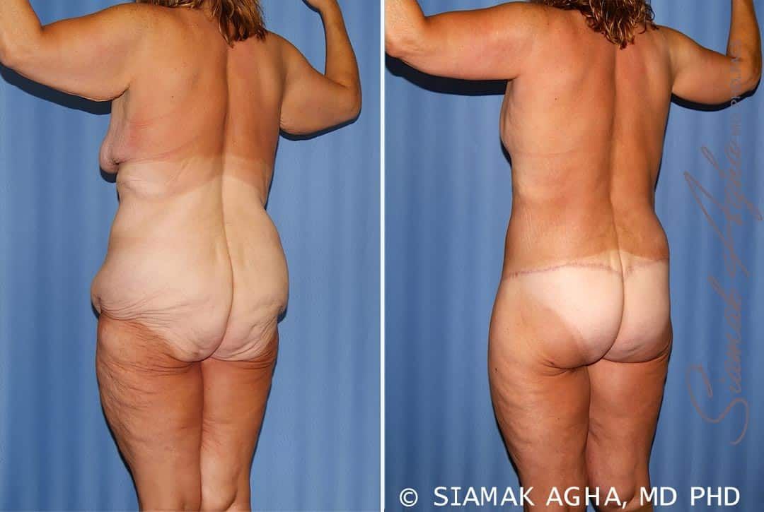 Total Body Lift Before & After