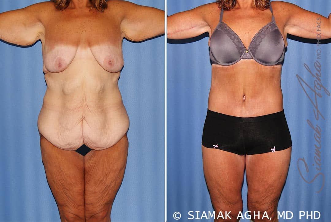 Total Body Lift Before & After