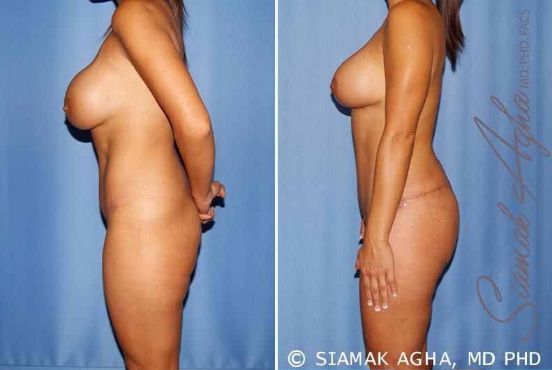 Total Body Lift Before & After