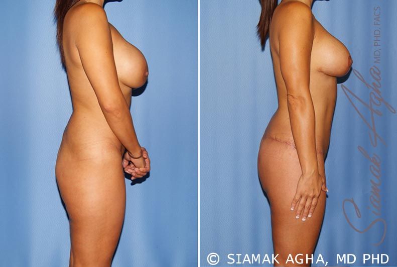 Total Body Lift Before & After