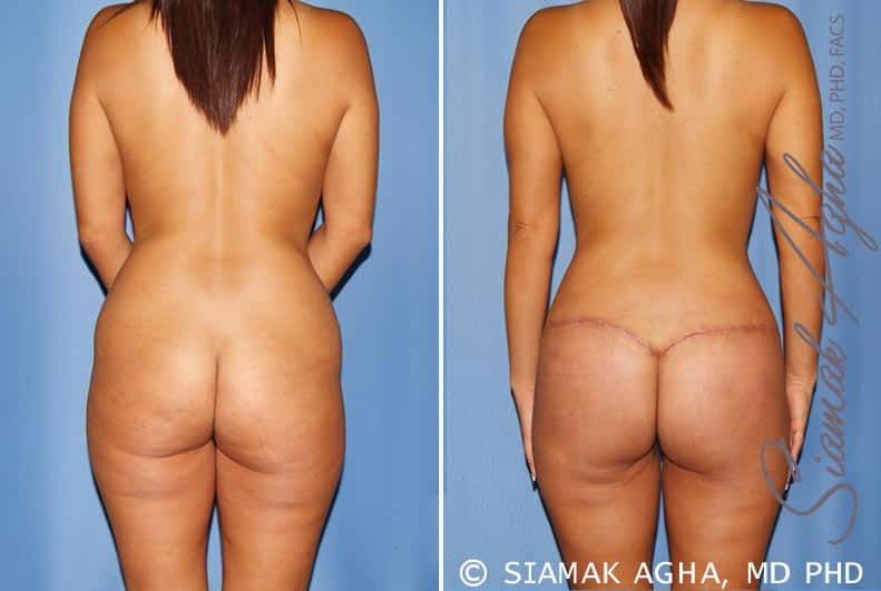 Total Body Lift Before & After