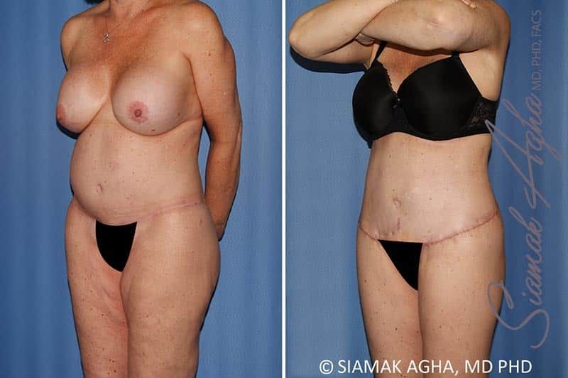 Total Body Lift Before & After