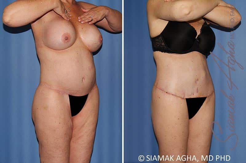 Total Body Lift Before & After