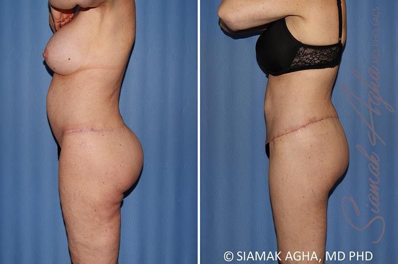 Total Body Lift Before & After