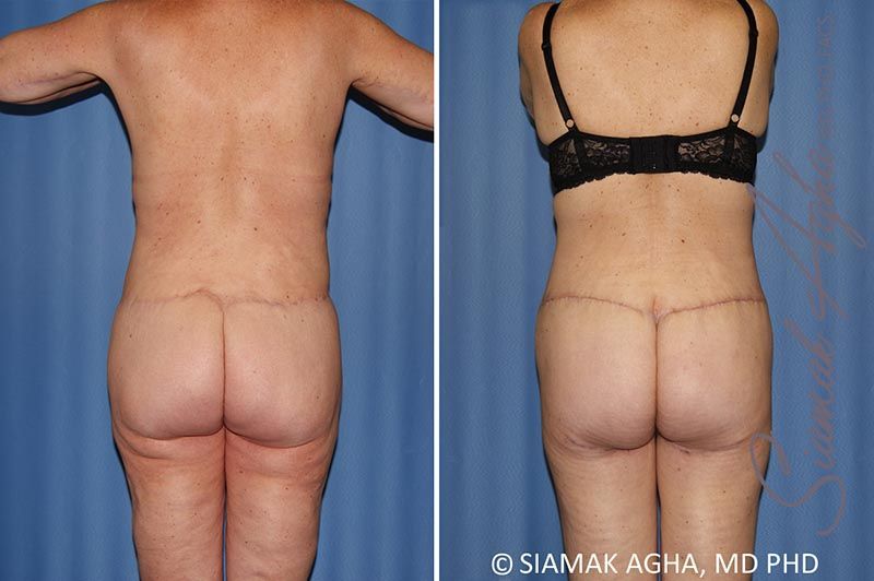 Total Body Lift Before & After