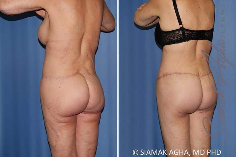 Total Body Lift Before & After
