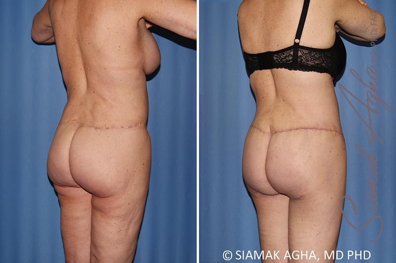 Total Body Lift Before & After