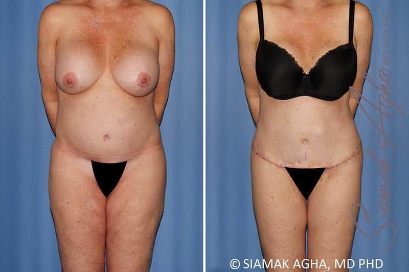 Total Body Lift Before & After