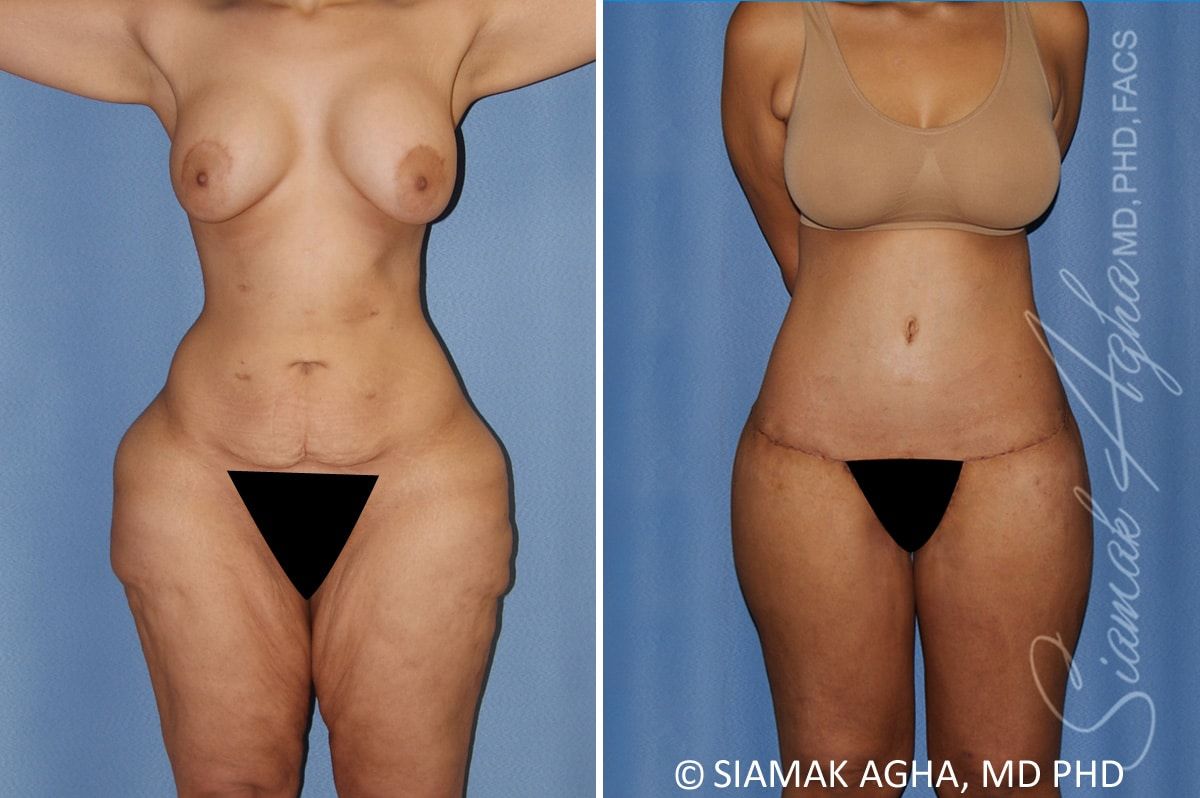 Total Body Lift Before & After