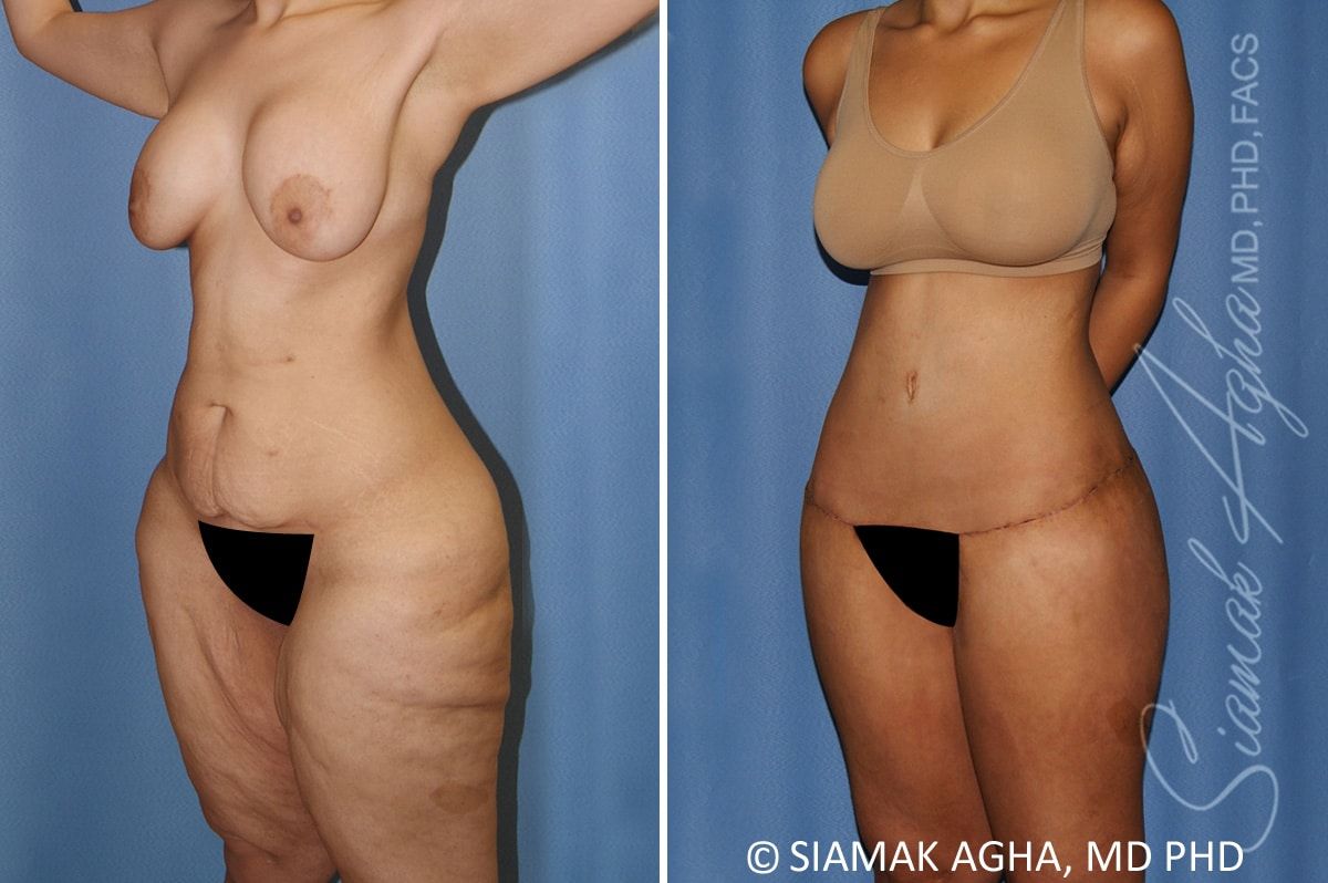 Total Body Lift Before & After