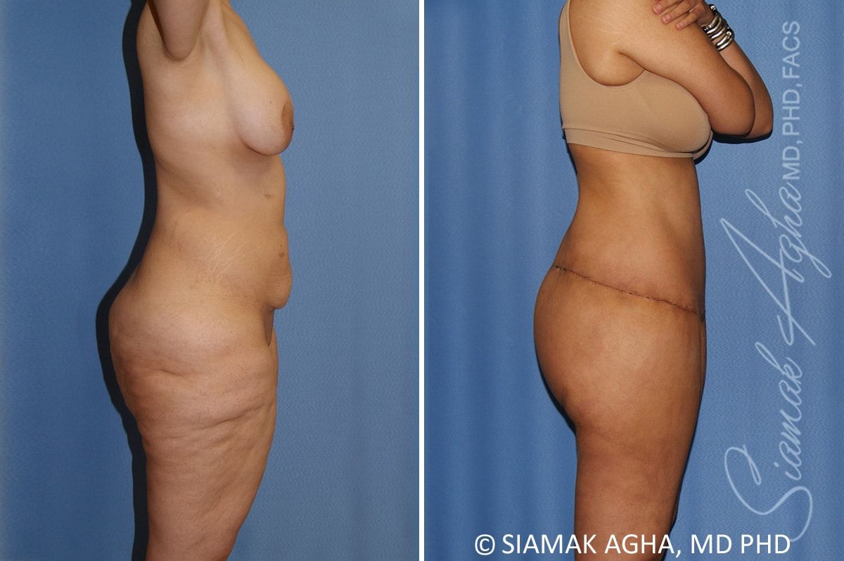 Total Body Lift Before & After