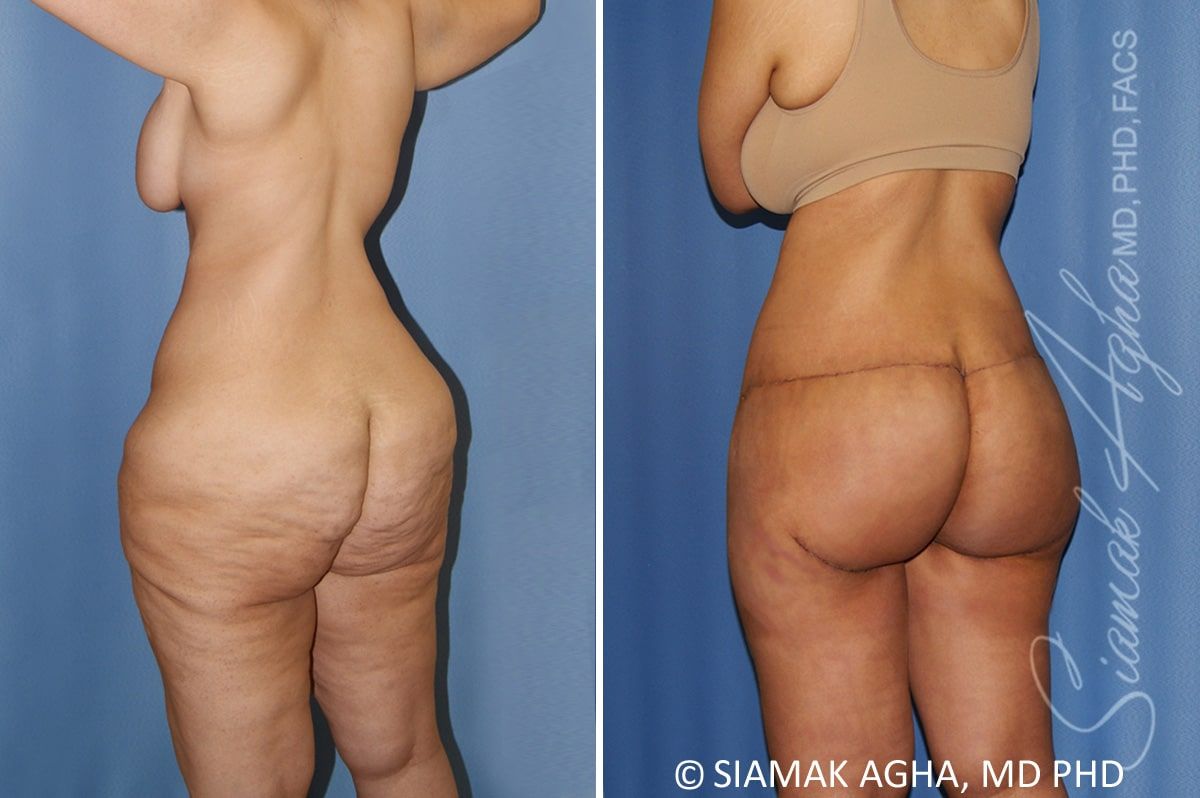 Total Body Lift Before & After