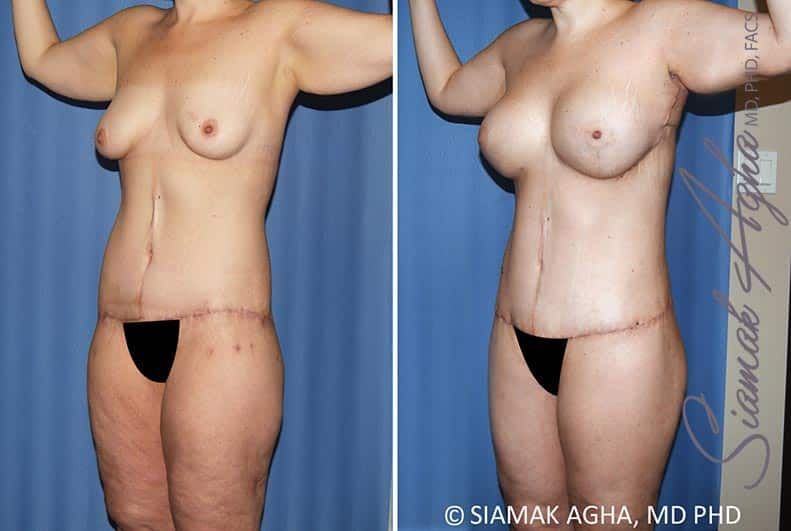 Total Body Lift Before & After