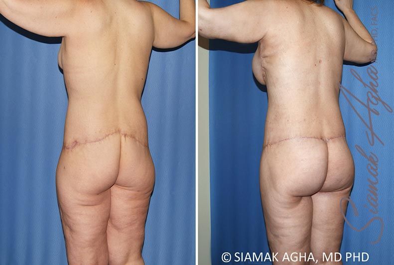 Total Body Lift Before & After