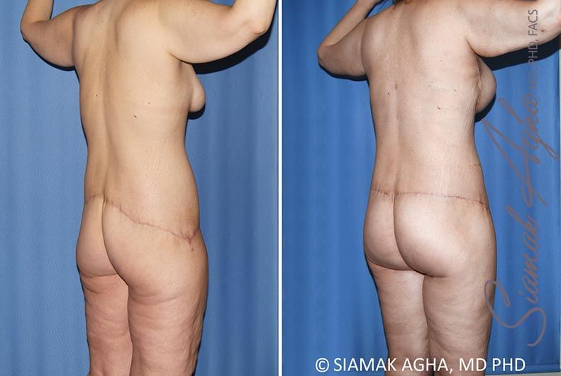 Total Body Lift Before & After