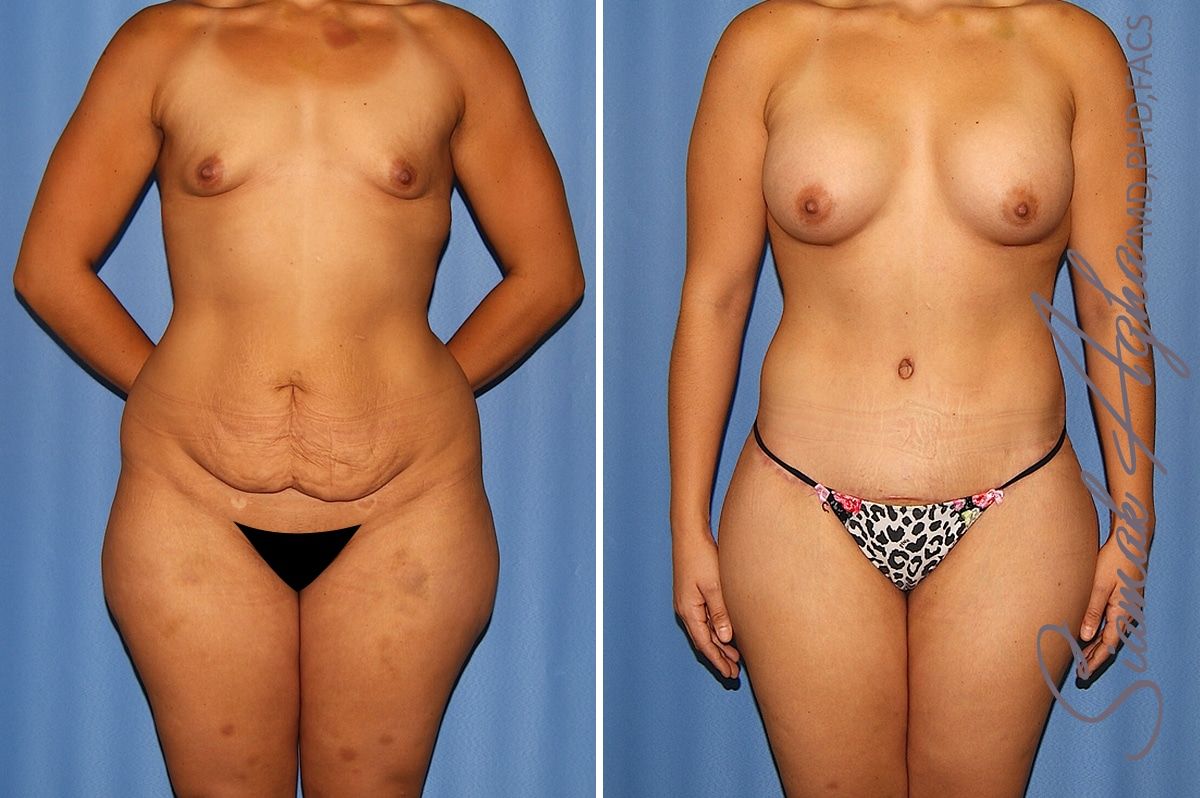 Total Body Lift Before & After