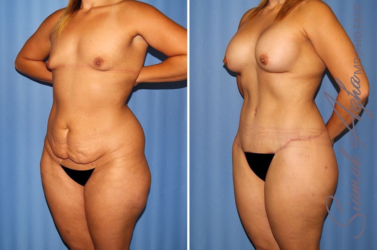 Total Body Lift Before & After