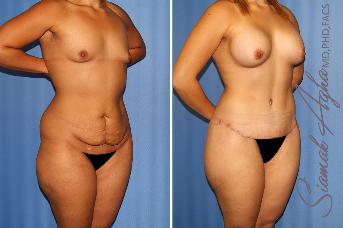 Total Body Lift Before & After