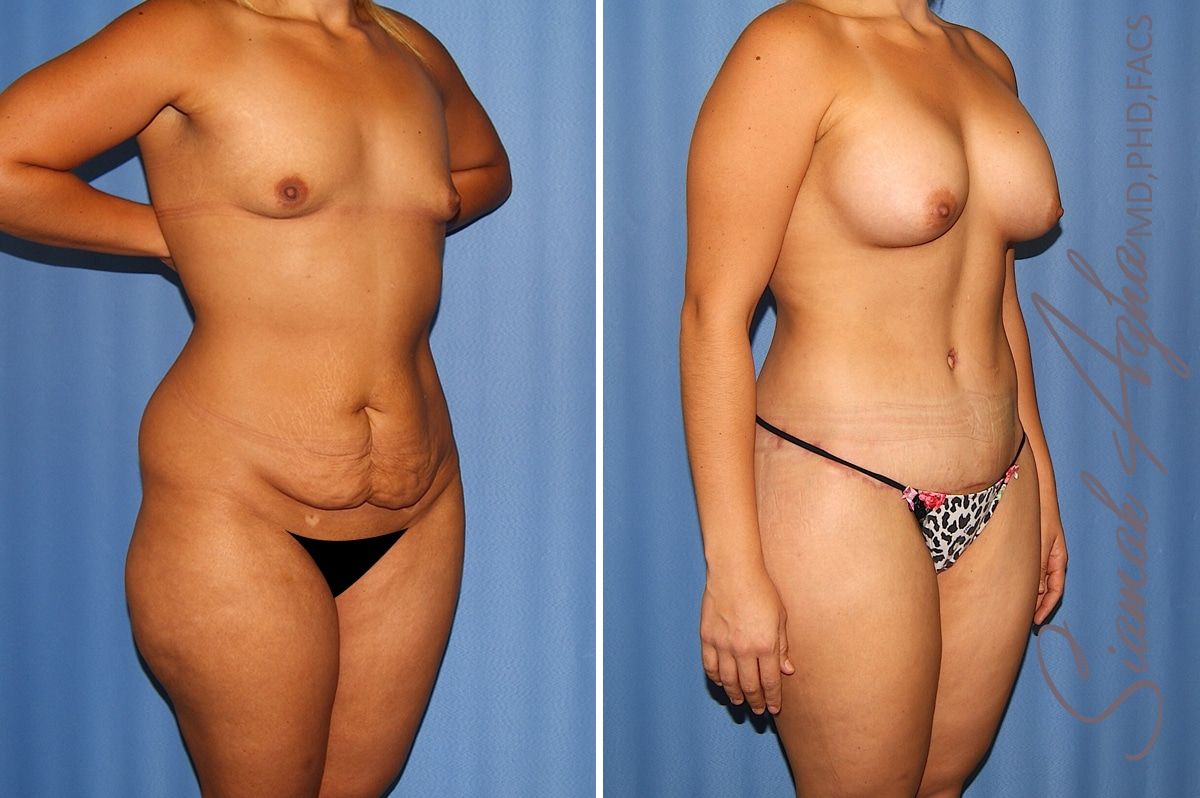 Total Body Lift Before & After