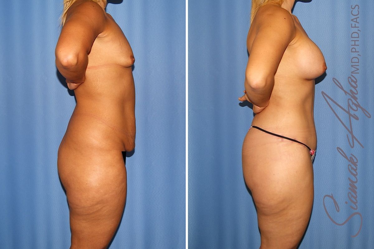 Total Body Lift Before & After