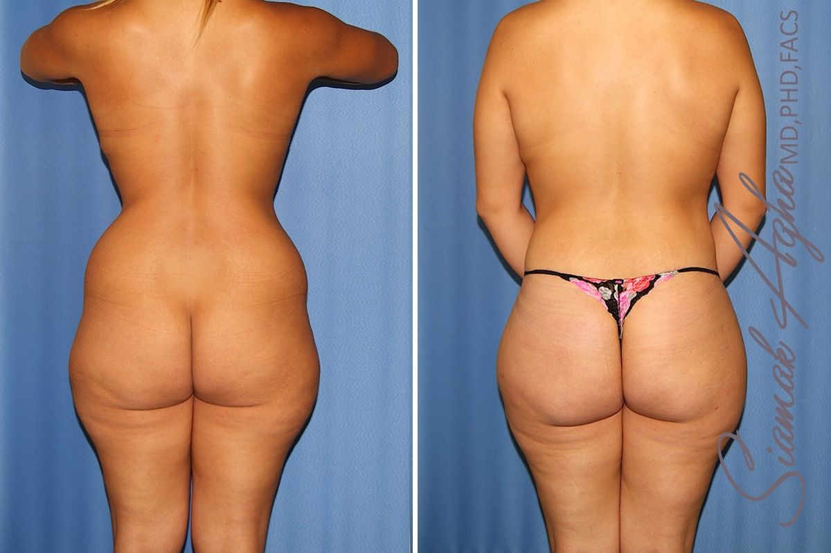 Total Body Lift Before & After