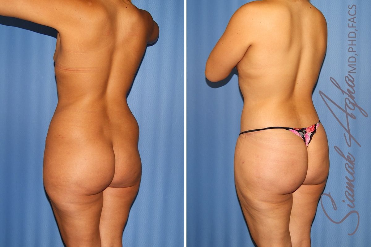Total Body Lift Before & After
