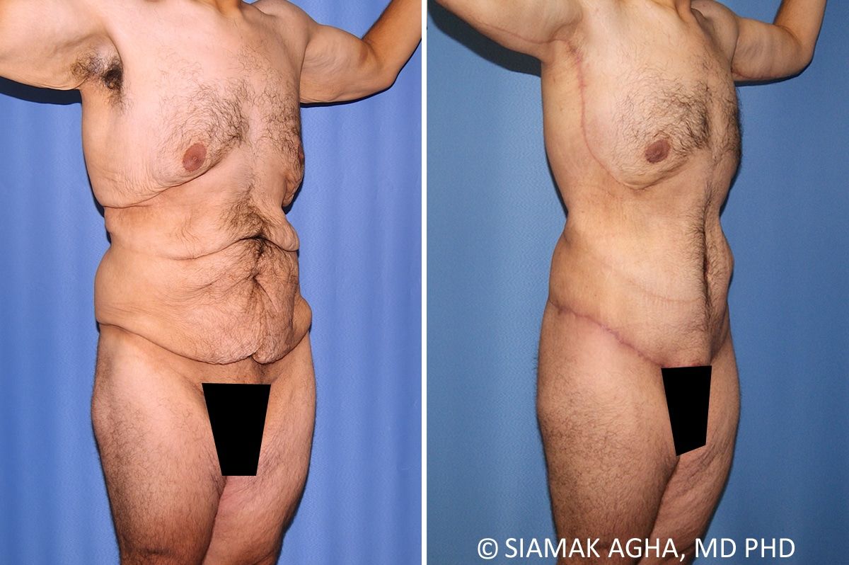 Total Body Lift Before & After