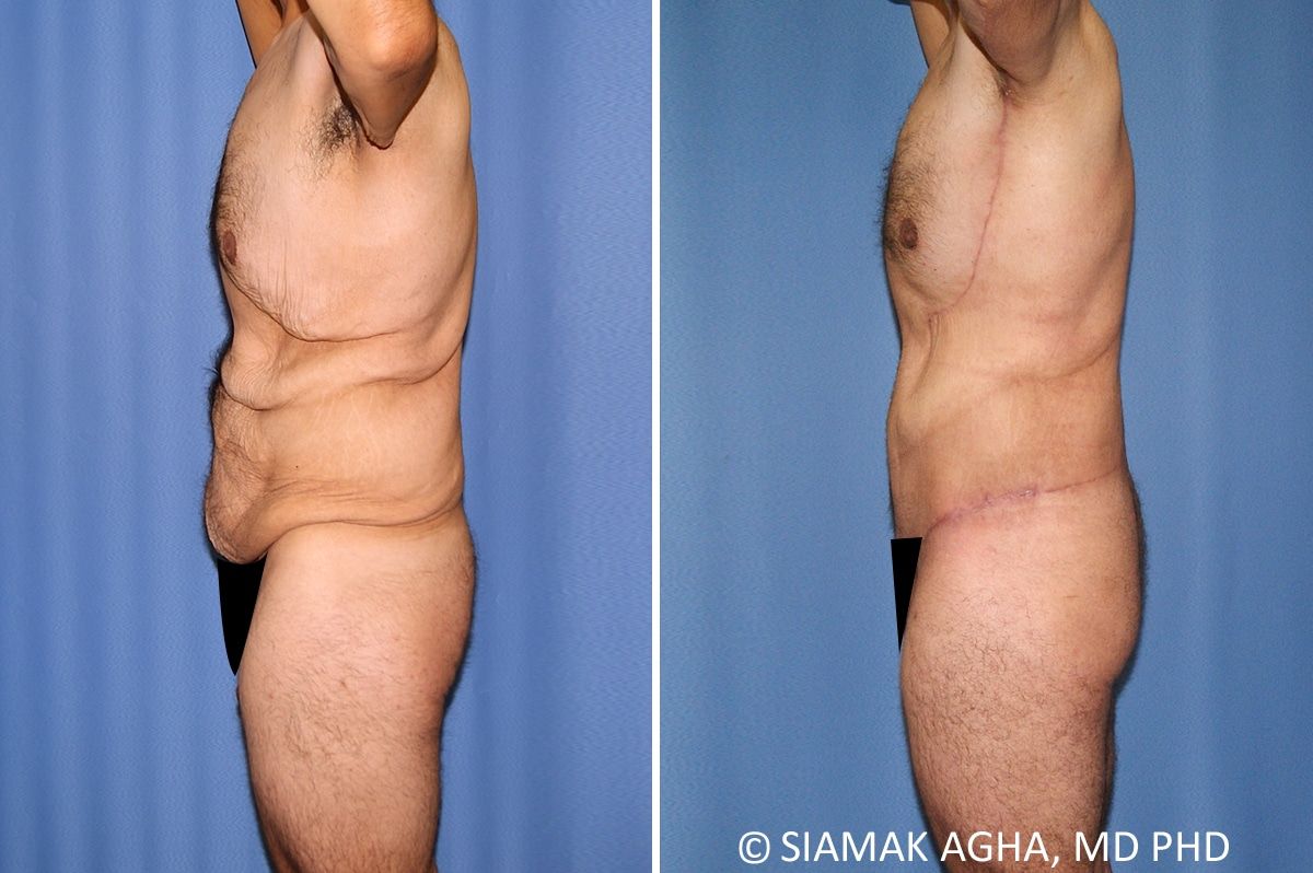 Total Body Lift Before & After