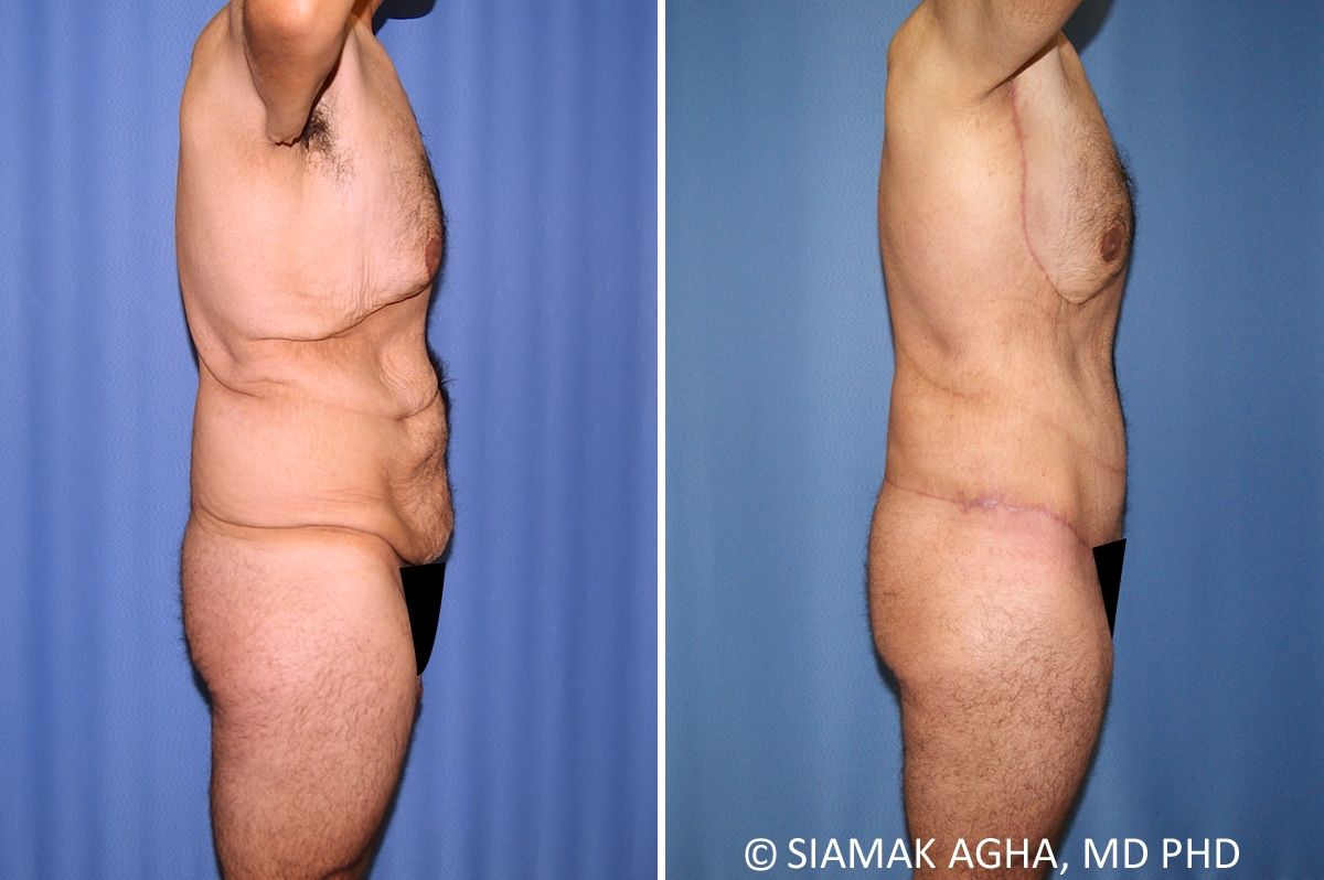 Total Body Lift Before & After