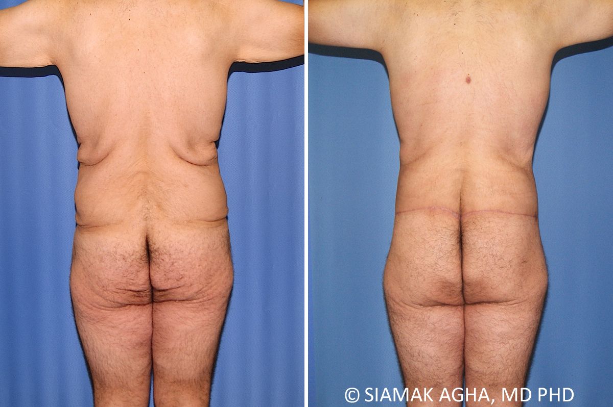 Total Body Lift Before & After