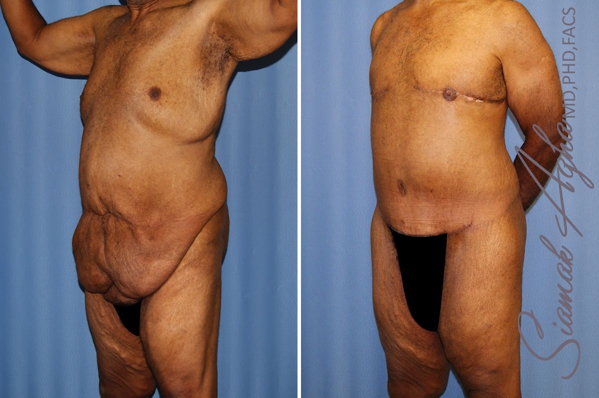 Total Body Lift Before & After