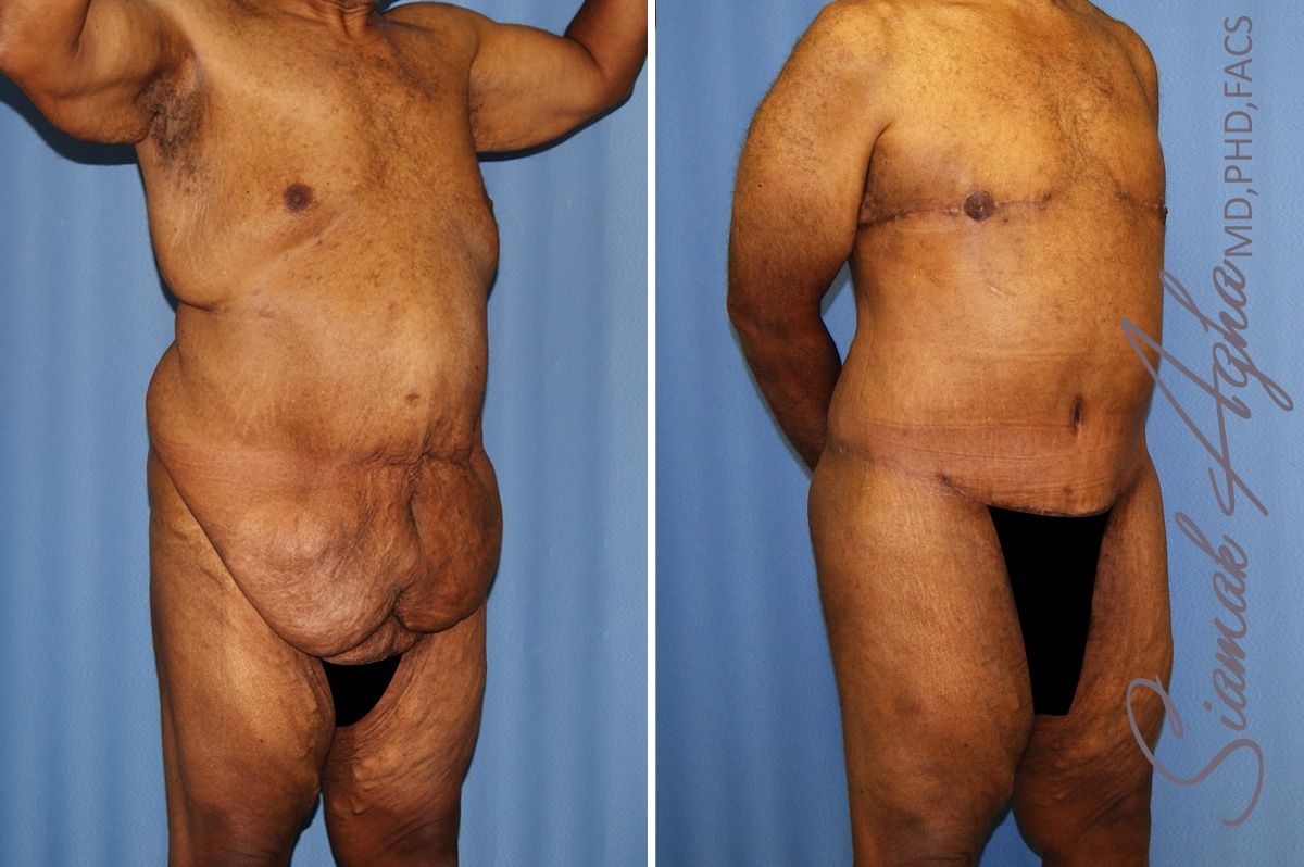 Total Body Lift Before & After