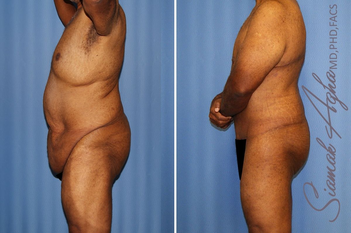 Total Body Lift Before & After