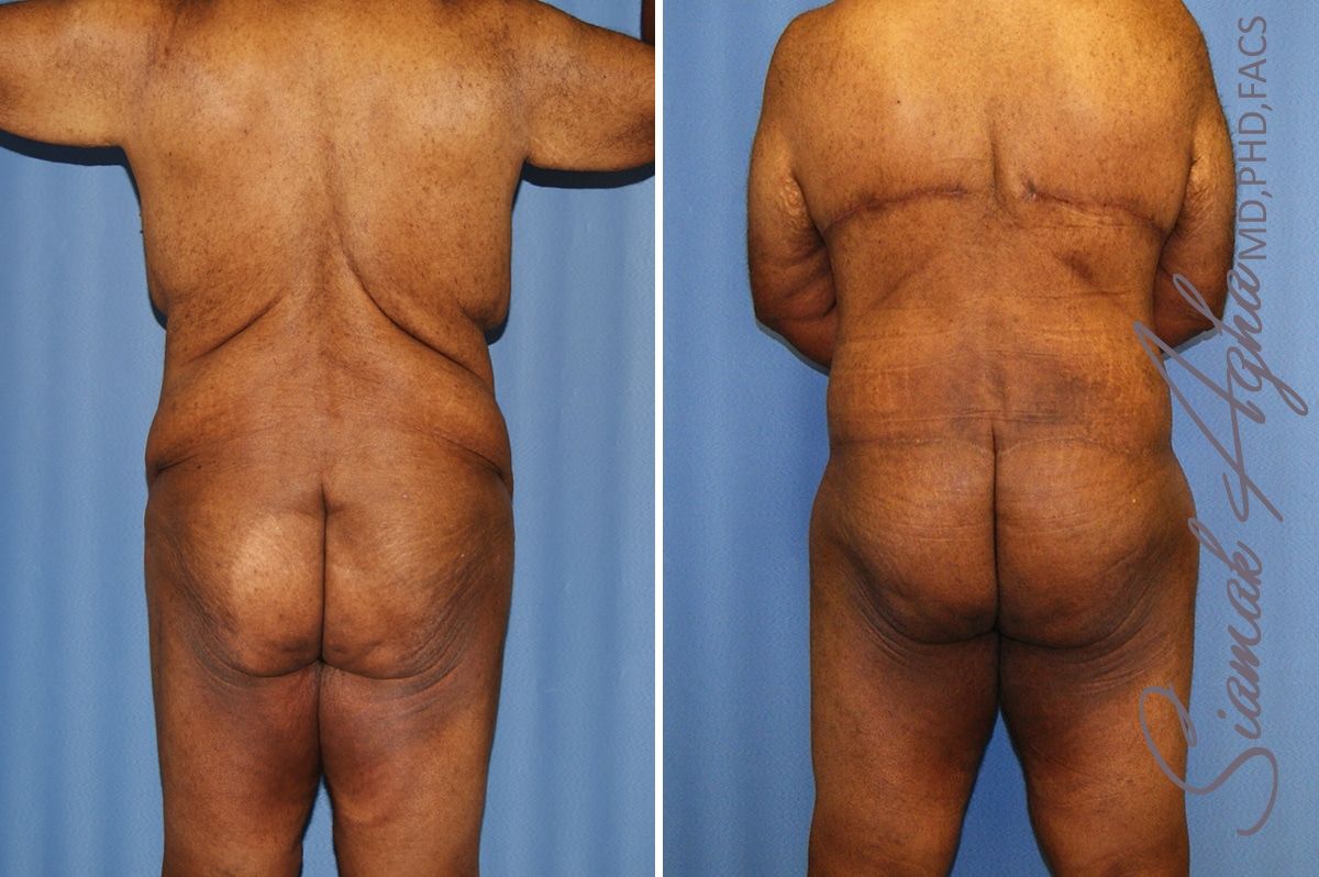 Total Body Lift Before & After