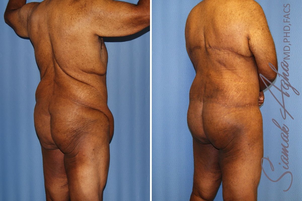 Total Body Lift Before & After