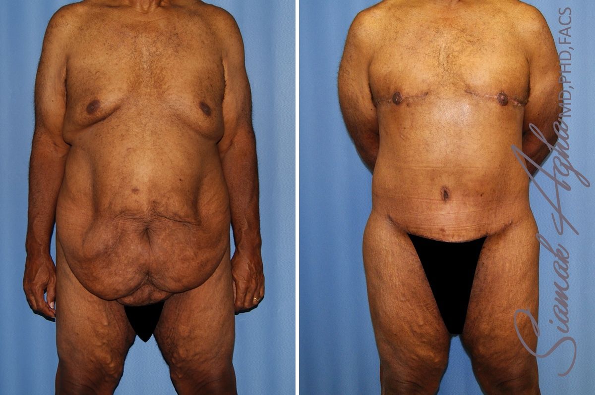 Total Body Lift Before & After