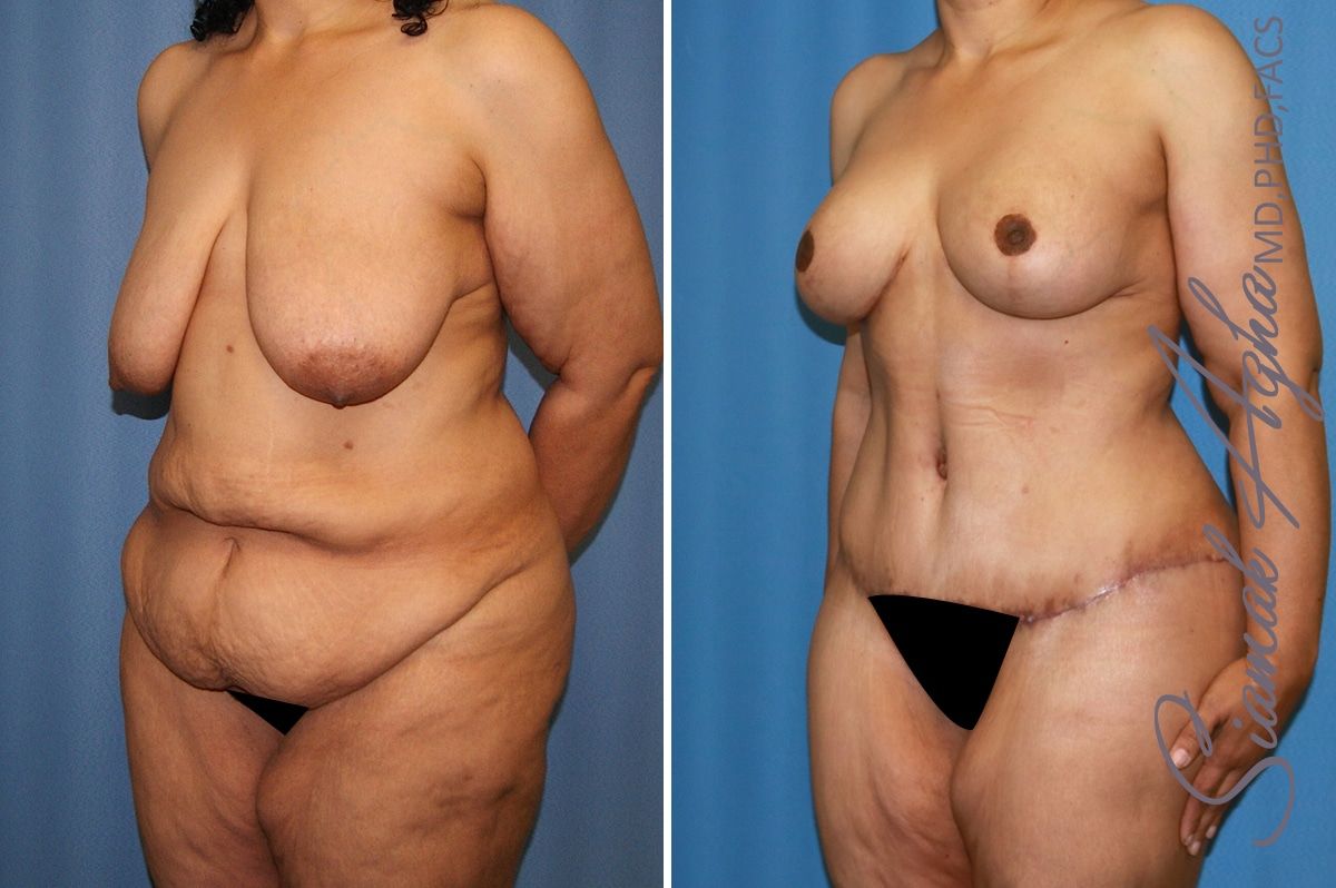 Total Body Lift Before & After