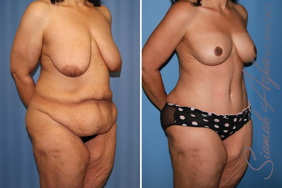 Total Body Lift Before & After