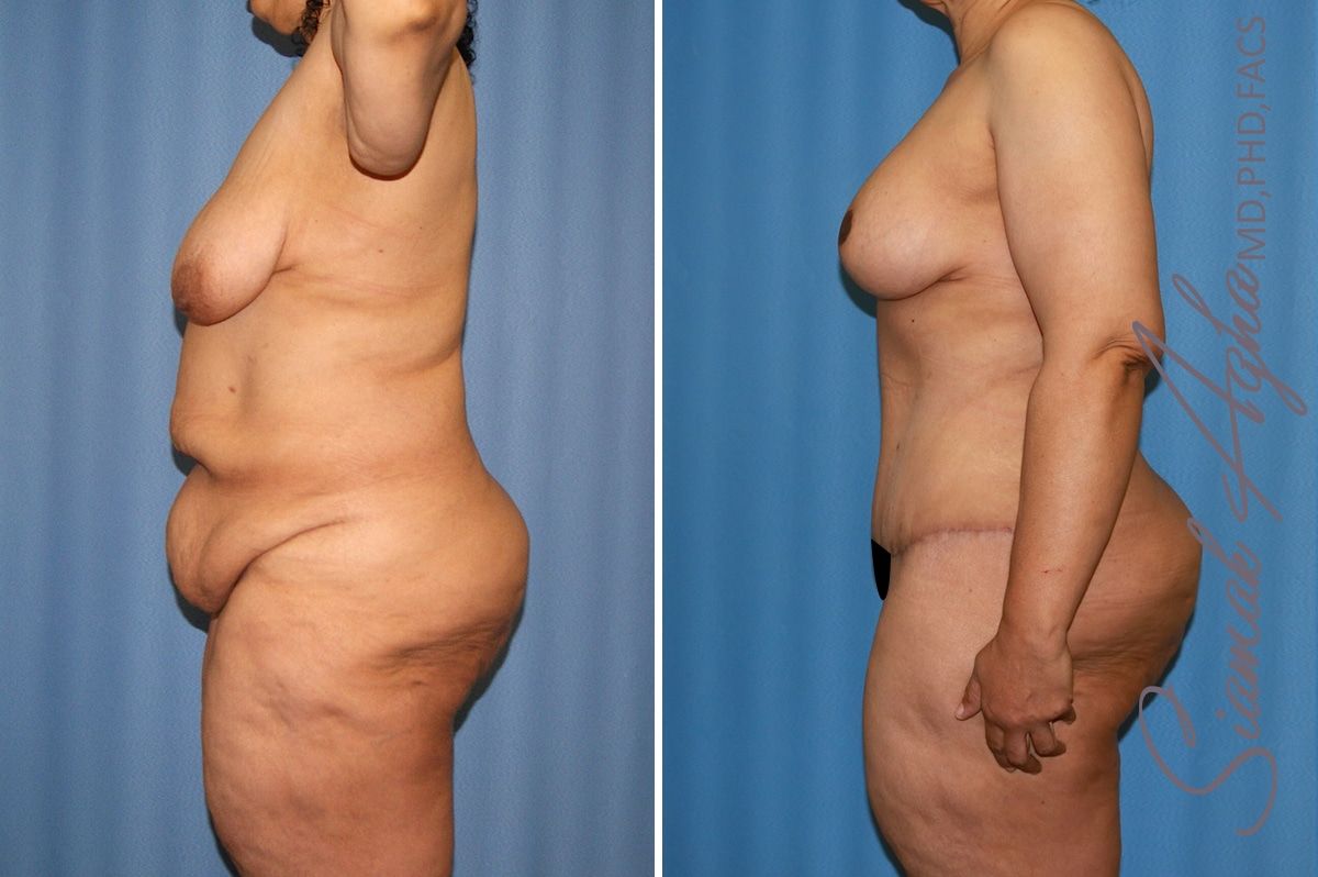 Total Body Lift Before & After