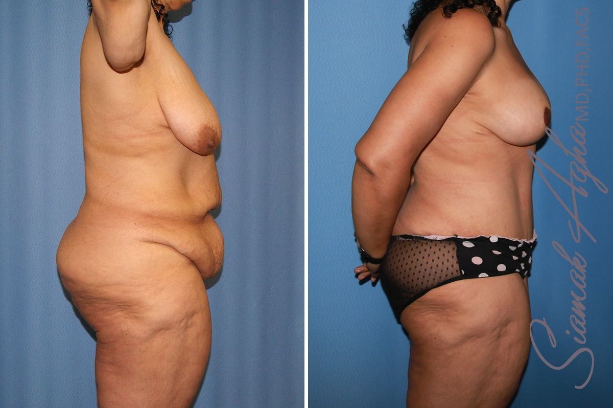 Total Body Lift Before & After