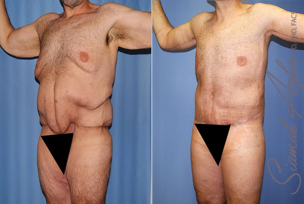Total Body Lift Before & After