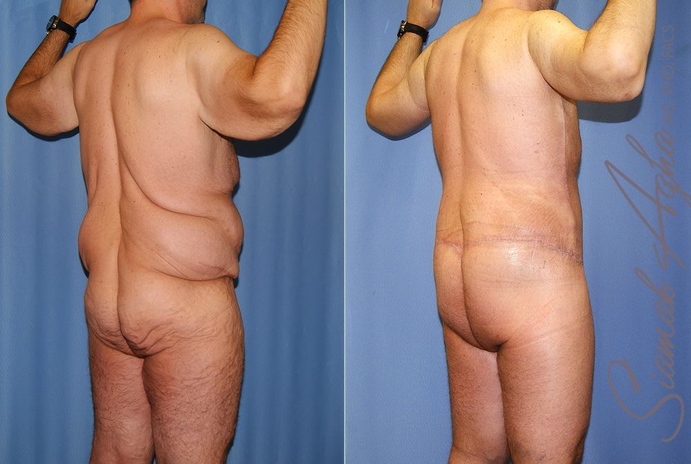 Total Body Lift Before & After