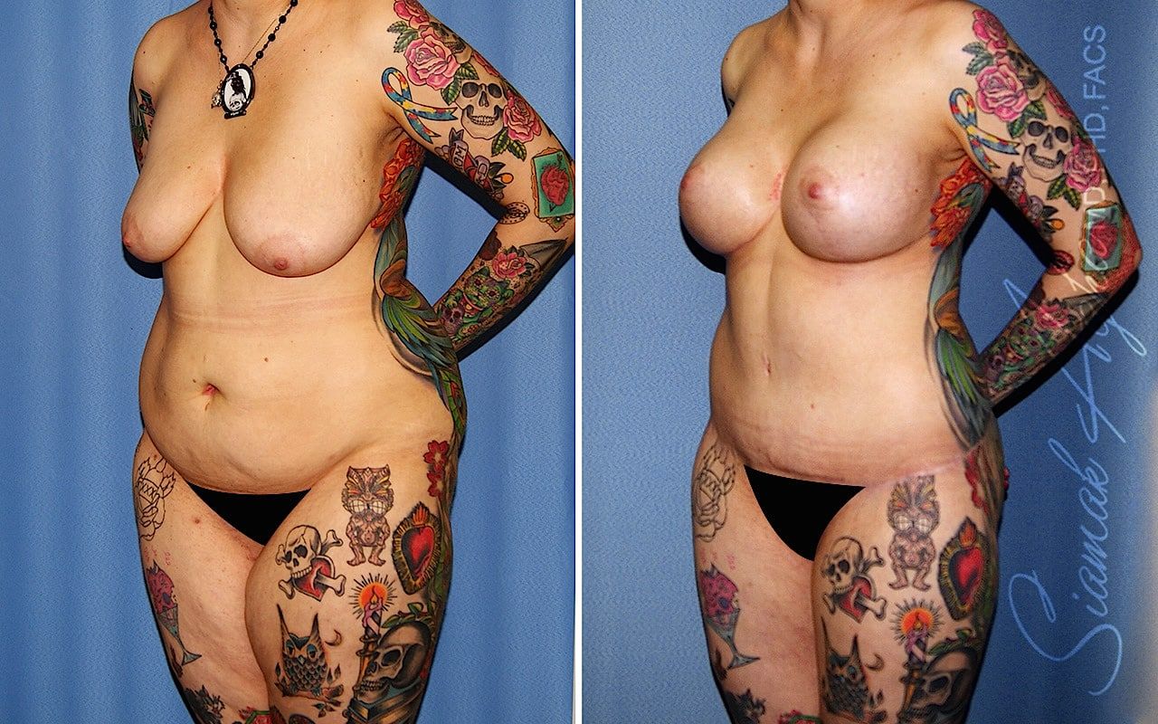 Total Body Lift Before & After