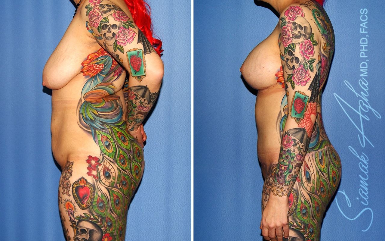 Total Body Lift Before & After