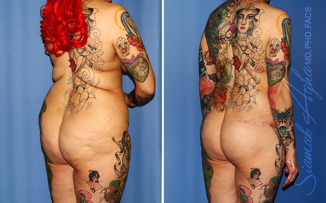 Total Body Lift Before & After