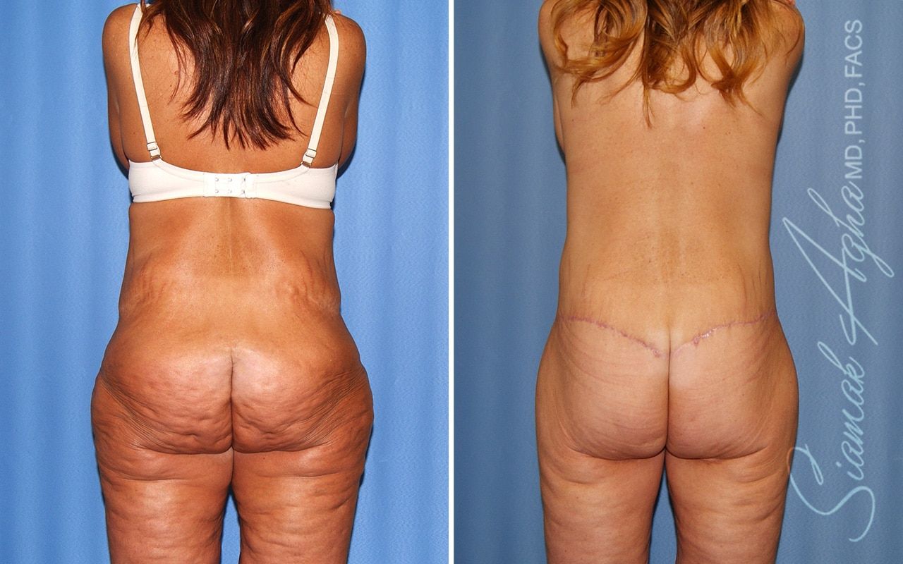 Total Body Lift Before & After