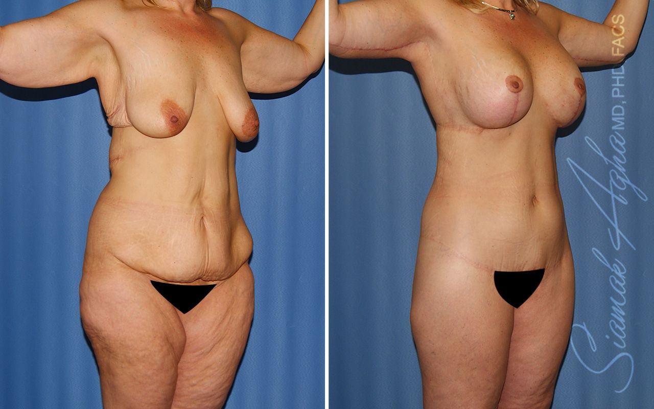 Total Body Lift Before & After